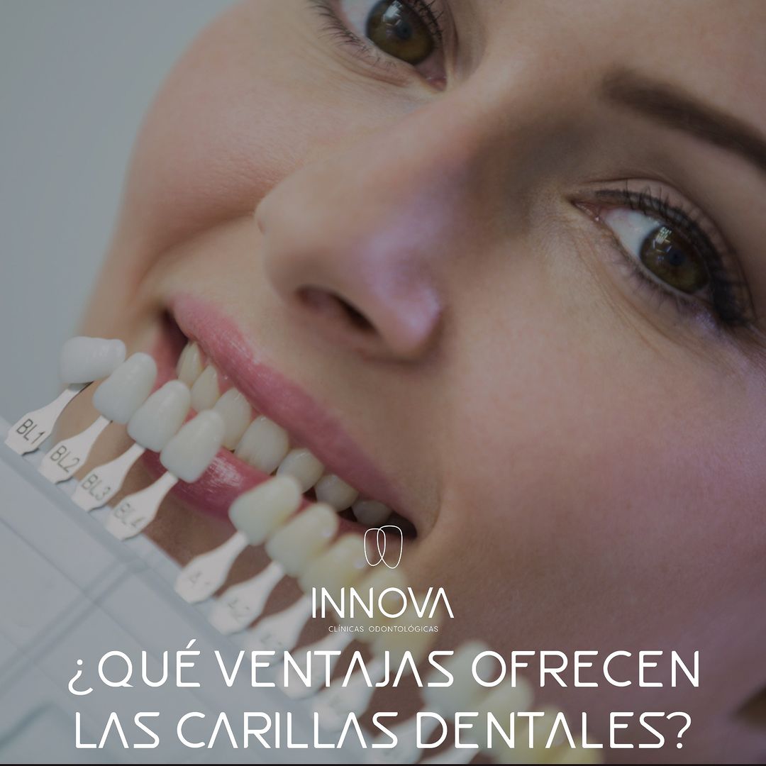 ¿Qué ventajas ofrecen las carillas dentales a tu sonrisa?