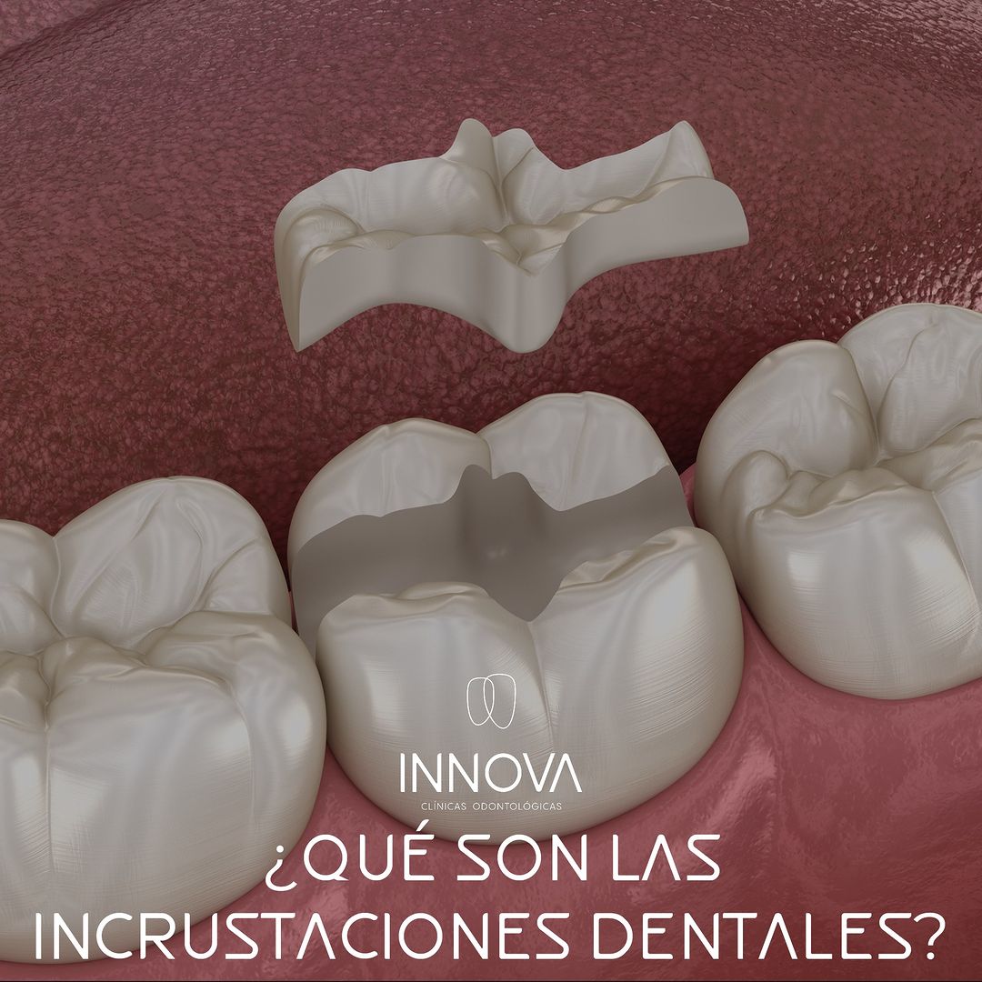 ¿Qué son las incrustaciones dentales? Tipos y cuándo se utilizan